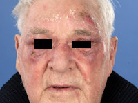 Erysipelas in het gelaat