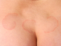Erythema annulare centrifugum