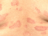 Erythema annulare centrifugum