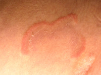 Erythema annulare centrifugum