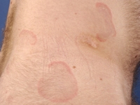 Erythema annulare centrifugum