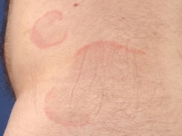 Erythema annulare centrifugum