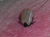 Erythema chronicum migrans