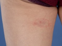 Erythema migrans