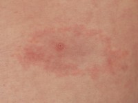 Erythema migrans