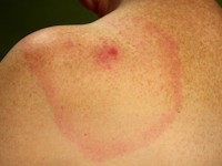 Erythema migrans