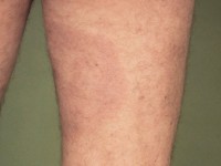 Erythema migrans