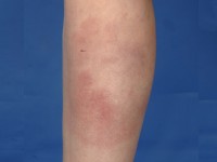 Erythema migrans