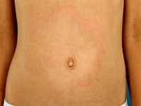 Erythema migrans