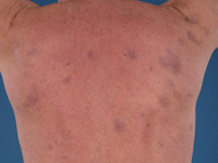Ashy dermatosis