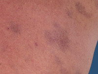 Ashy dermatosis