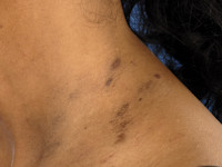 Ashy dermatosis