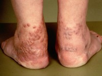 Erythema elevatum diutinum
