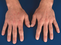 Erythema elevatum diutinum
