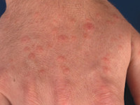 Erythema elevatum diutinum