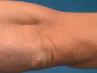 Erythema elevatum diutinum