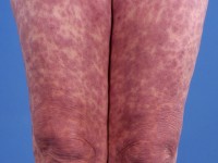Erythema exsudativum multiforme