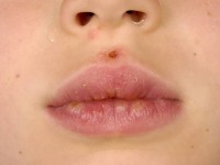 Erythema exsudativum multiforme