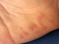 Erythema exsudativum multiforme