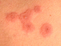 Erythema exsudativum multiforme
