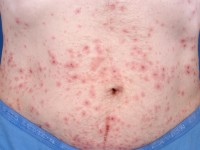 Erythema exsudativum multiforme