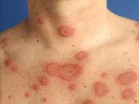 Erythema exsudativum multiforme