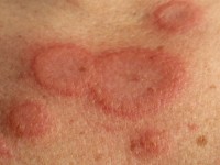Erythema exsudativum multiforme