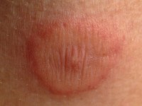 Erythema exsudativum multiforme