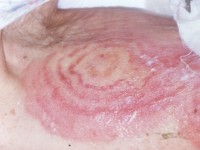 erythema gyratum repens