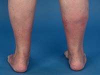 Erythema induratum Bazin