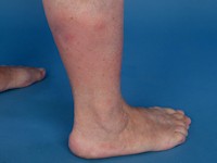 Erythema induratum Bazin