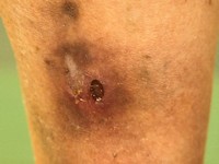 Erythema induratum Bazin
