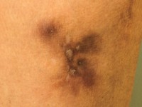 Erythema induratum Bazin