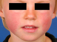Slapped cheeks in erythema infectiosum