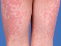 Confluent rings in erythema infectiosum