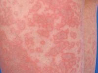 Confluerende ringen bij erythema infectiosum