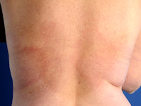 Erythema marginatum
