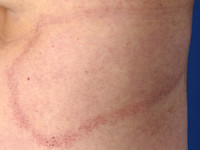 Erythema marginatum
