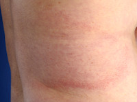 Erythema marginatum