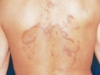 erythema migrans arciforme et palpabile