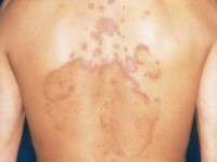 erythema migrans arciforme et palpabile