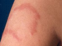 erythema migrans arciforme et palpabile