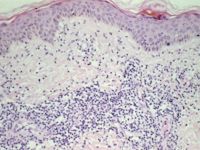 erythema migrans arciforme et palpabile