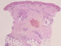 Erythema nodosum histologie