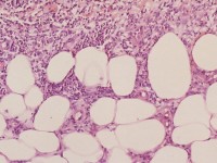 Erythema nodosum histologie