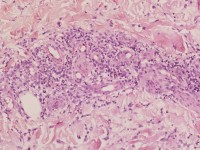 Erythema nodosum histologie