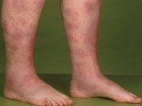 Erythema nodosum in sarcoidosis