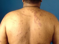Erythema nodosum leprosum