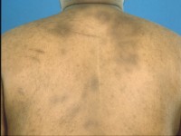 Erythema nodosum leprosum