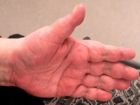 Erythema palmare